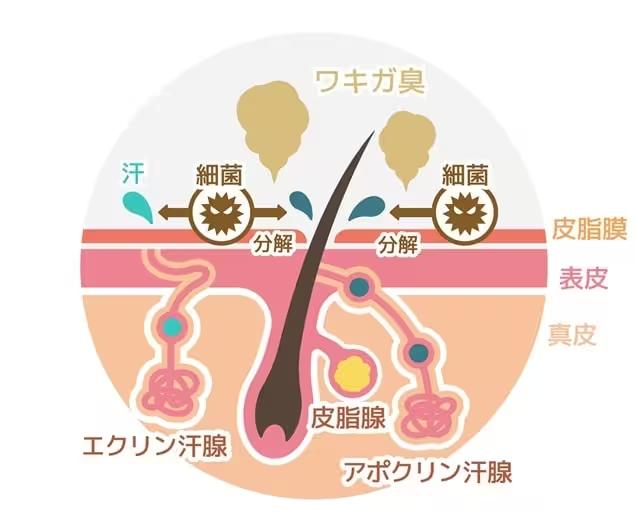 そもそもワキガ（腋臭症）とは？